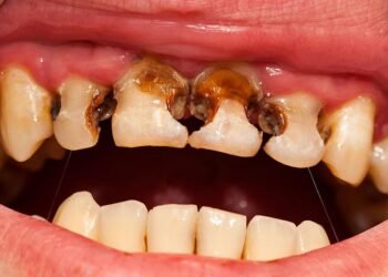 Santé: Tout savoir sur les causes et conséquences de la carie dentaire avec Docteur Mamadou Saliou Baldé